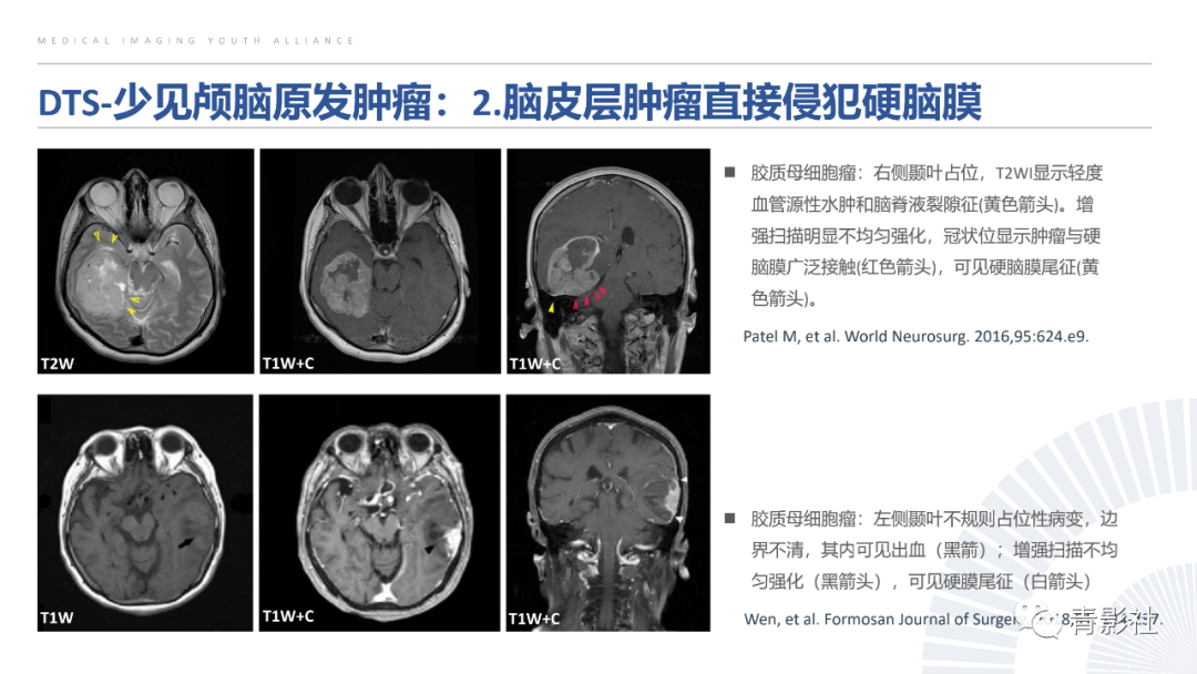 影像PPT - 【PPT】颅脑硬膜尾征：beyond meningioma-3