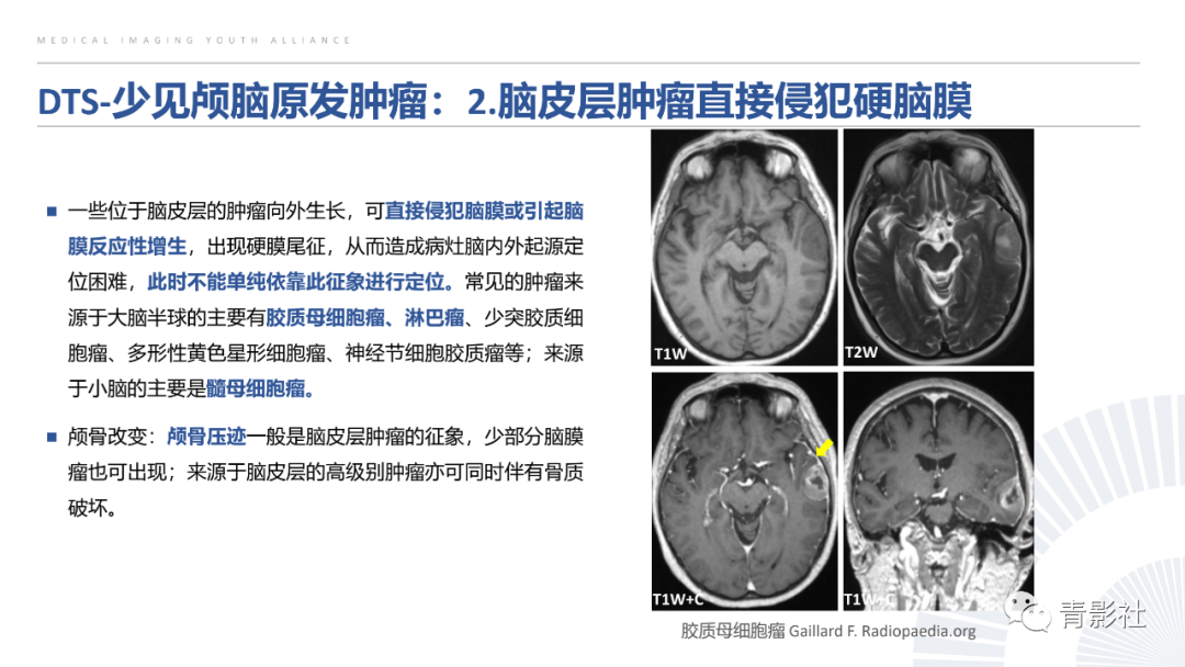 影像PPT - 【PPT】颅脑硬膜尾征：beyond meningioma-2
