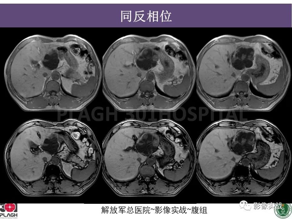 影像PPT - 【病例】肝内胆管囊腺癌1例MR-8