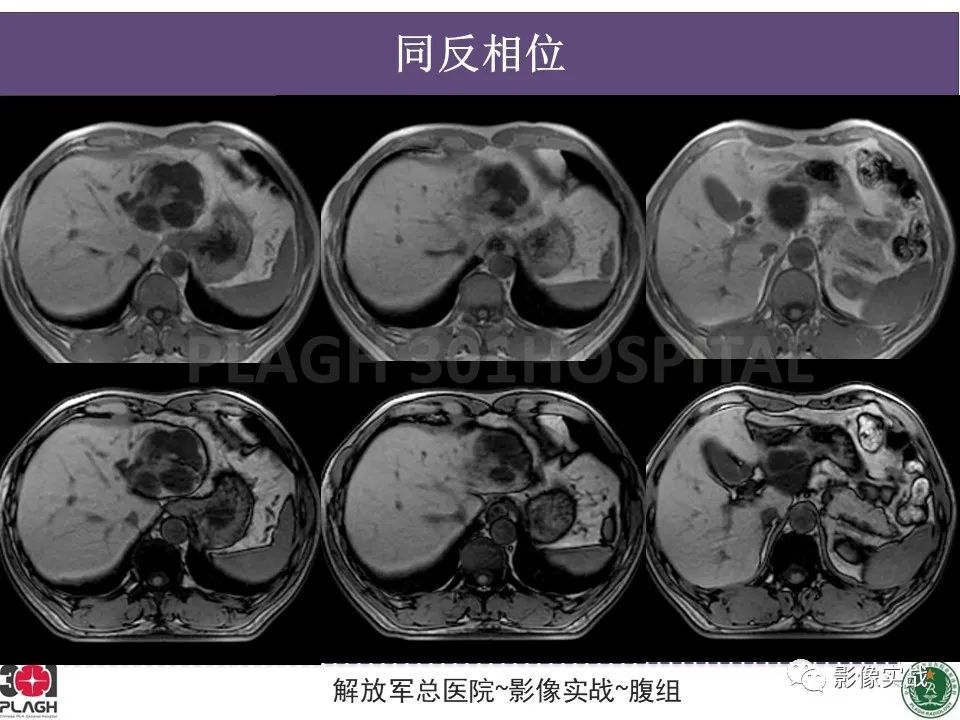 影像PPT - 【病例】肝内胆管囊腺癌1例MR-9