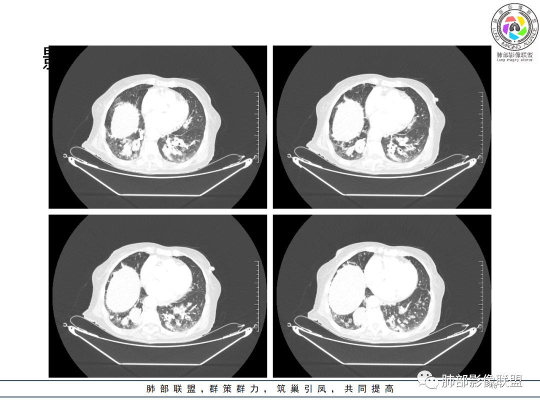 影像PPT - 【病例】围绕中轴间质的弥漫大B淋巴瘤-15 影像PPT - 【病例】围绕中轴间质的弥漫大B淋巴瘤-15