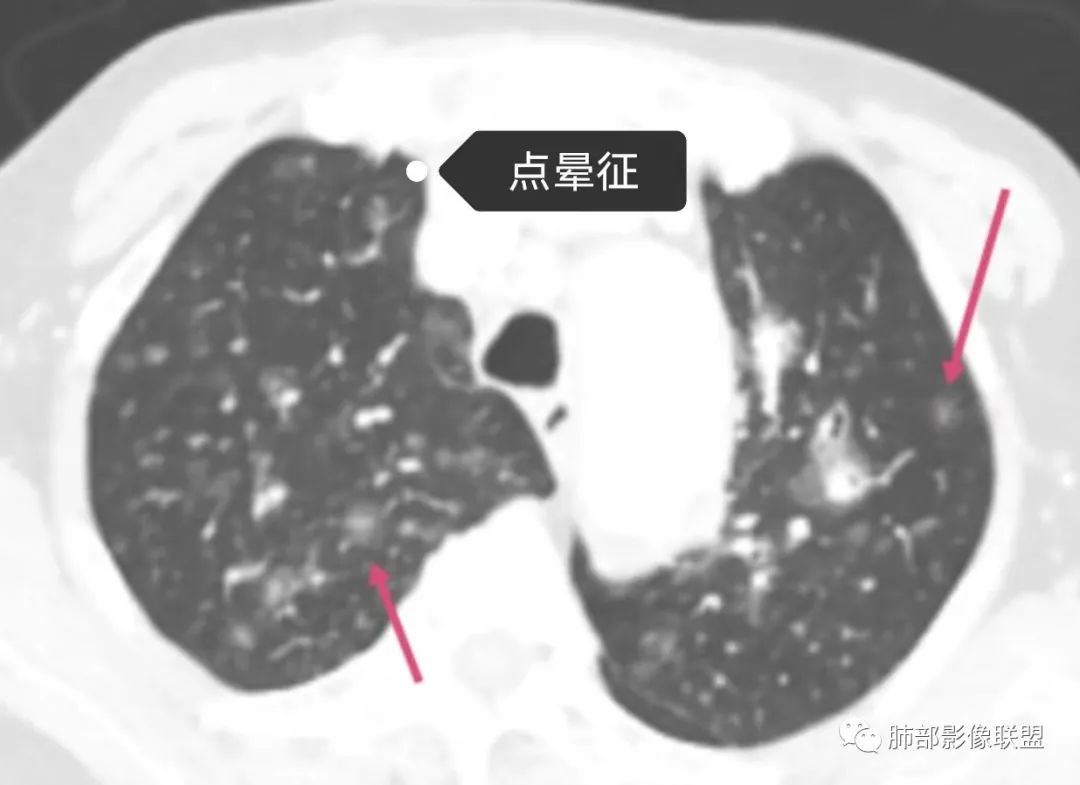 影像PPT - 【病例】围绕中轴间质的弥漫大B淋巴瘤-22 影像PPT - 【病例】围绕中轴间质的弥漫大B淋巴瘤-22