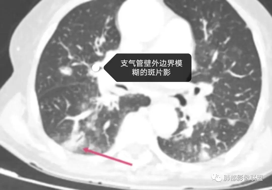 影像PPT - 【病例】围绕中轴间质的弥漫大B淋巴瘤-23 影像PPT - 【病例】围绕中轴间质的弥漫大B淋巴瘤-23