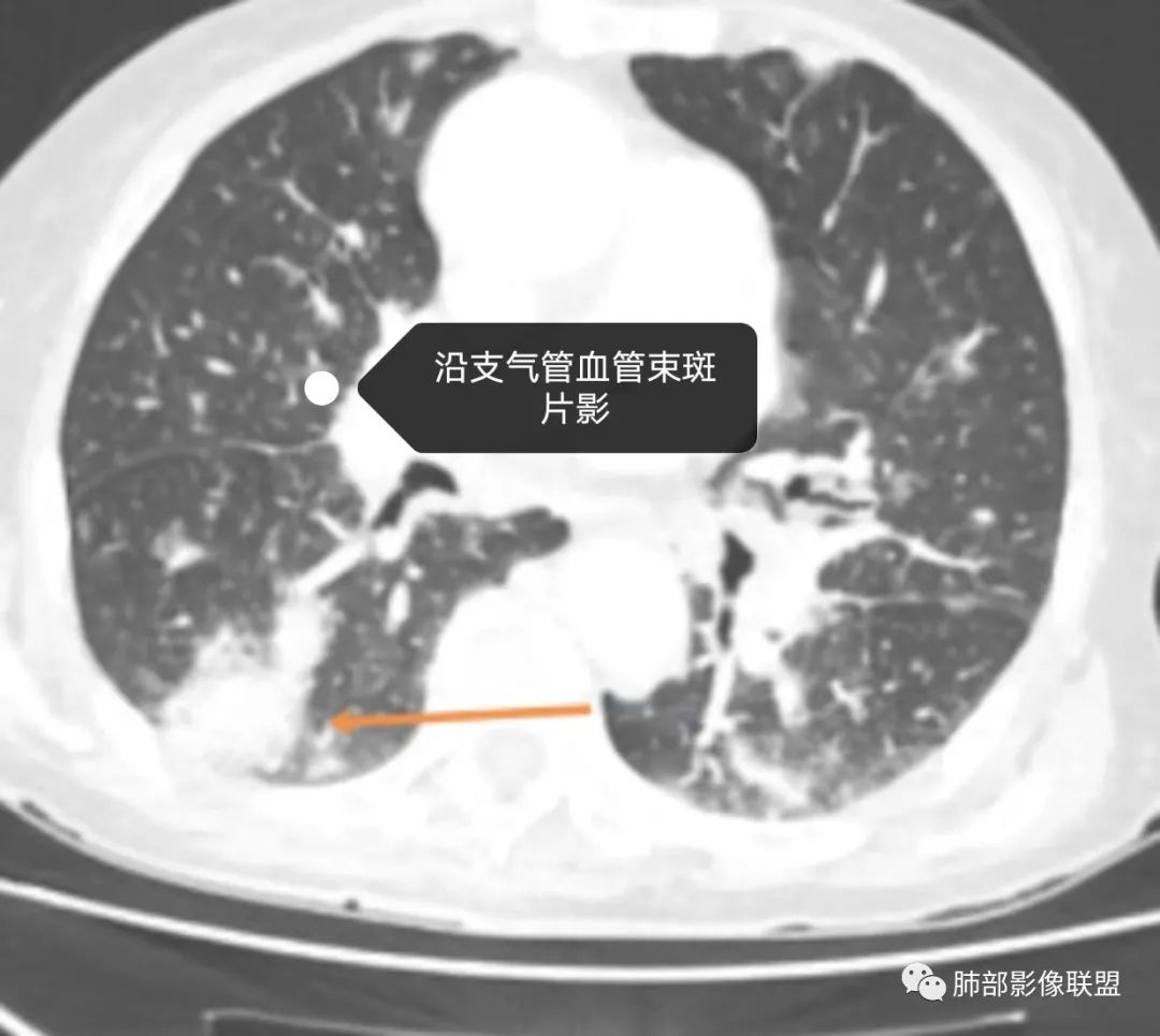 影像PPT - 【病例】围绕中轴间质的弥漫大B淋巴瘤-24 影像PPT - 【病例】围绕中轴间质的弥漫大B淋巴瘤-24