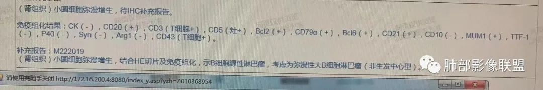 影像PPT - 【病例】围绕中轴间质的弥漫大B淋巴瘤-25 影像PPT - 【病例】围绕中轴间质的弥漫大B淋巴瘤-25
