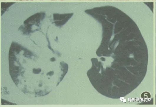 影像PPT - 【病例】围绕中轴间质的弥漫大B淋巴瘤-32 影像PPT - 【病例】围绕中轴间质的弥漫大B淋巴瘤-32