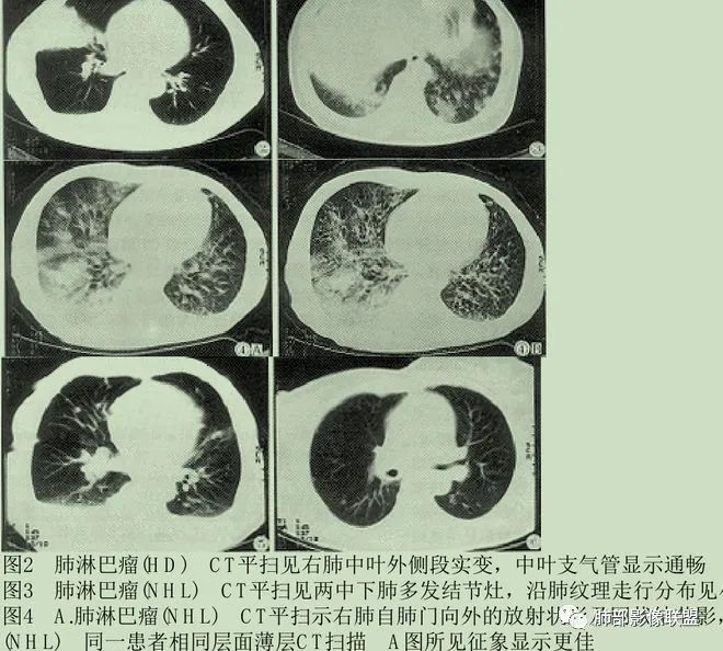 影像PPT - 【病例】围绕中轴间质的弥漫大B淋巴瘤-33 影像PPT - 【病例】围绕中轴间质的弥漫大B淋巴瘤-33