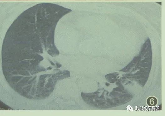 影像PPT - 【病例】围绕中轴间质的弥漫大B淋巴瘤-34 影像PPT - 【病例】围绕中轴间质的弥漫大B淋巴瘤-34