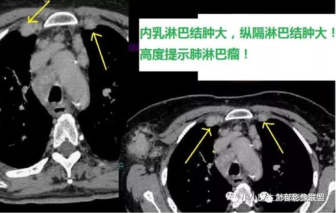影像PPT - 【病例】围绕中轴间质的弥漫大B淋巴瘤-36 影像PPT - 【病例】围绕中轴间质的弥漫大B淋巴瘤-36