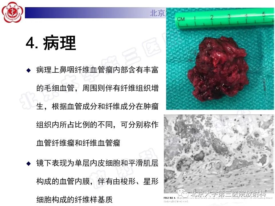 影像PPT - 【PPT】鼻咽纤维血管瘤-11