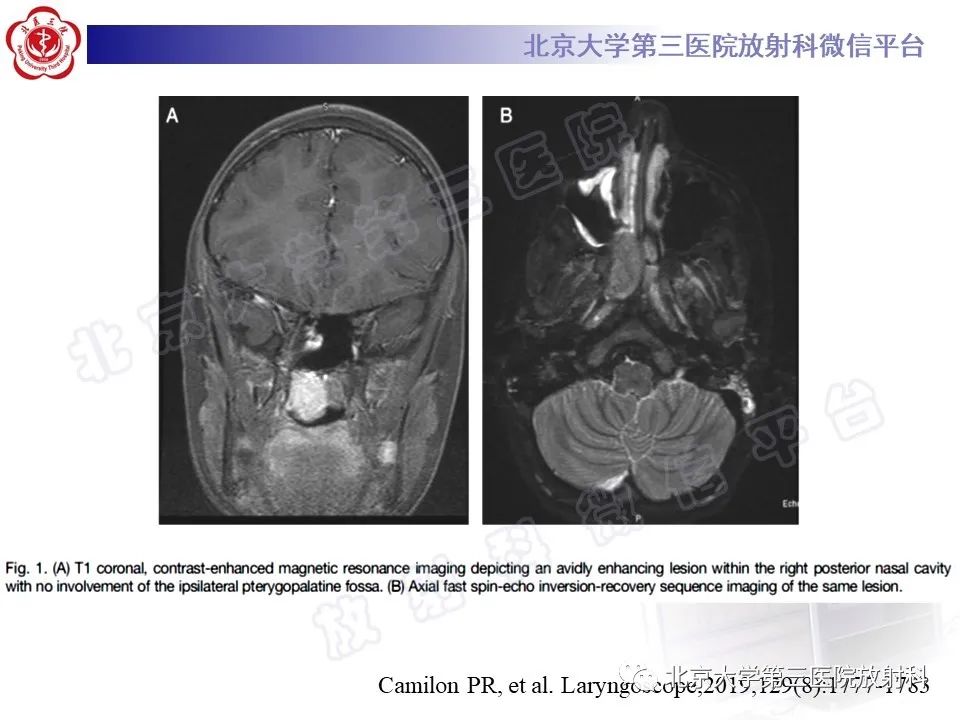 影像PPT - 【PPT】鼻咽纤维血管瘤-18