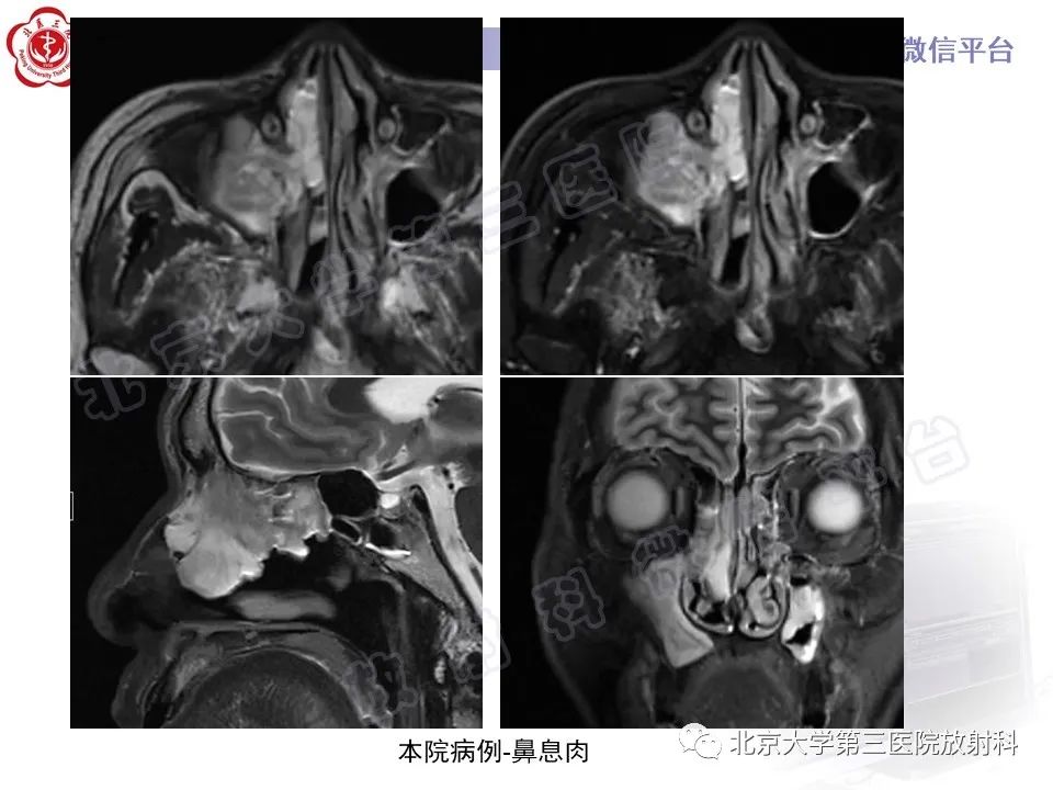 影像PPT - 【PPT】鼻咽纤维血管瘤-24
