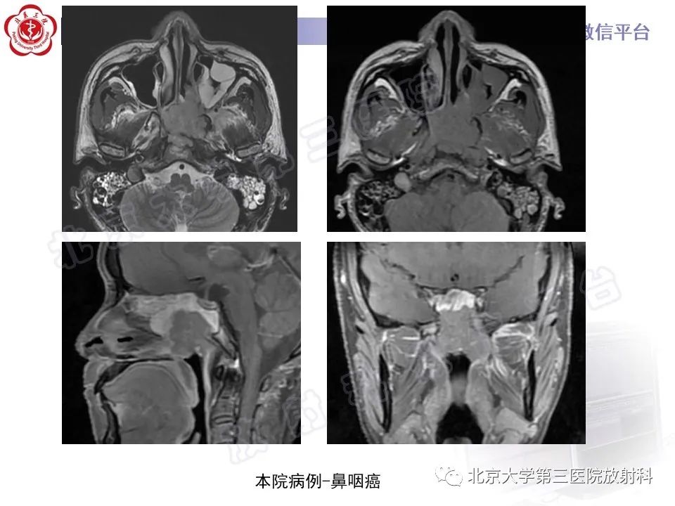 影像PPT - 【PPT】鼻咽纤维血管瘤-26