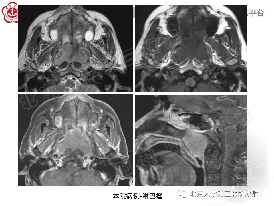 影像PPT - 【PPT】鼻咽纤维血管瘤-28