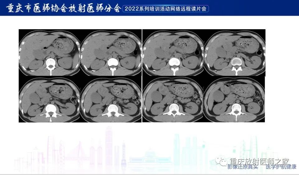 影像PPT - 【病例】肿块型胰腺炎1例CT及MR-4
