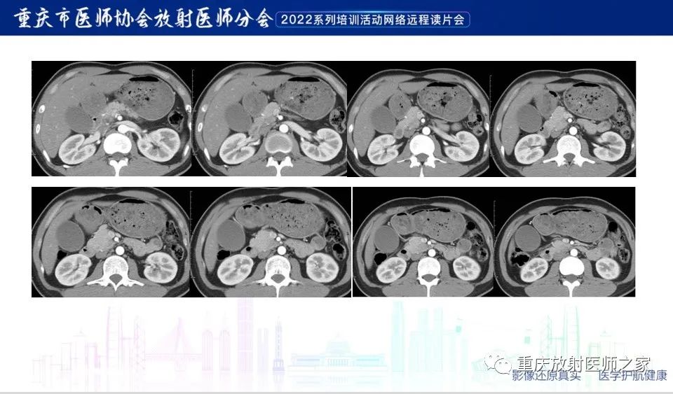 影像PPT - 【病例】肿块型胰腺炎1例CT及MR-5