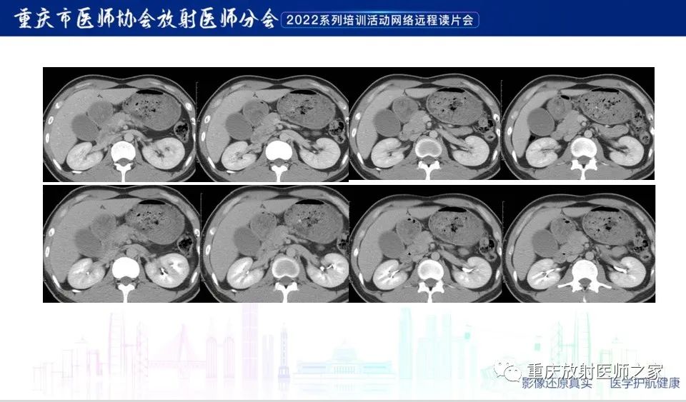 影像PPT - 【病例】肿块型胰腺炎1例CT及MR-6