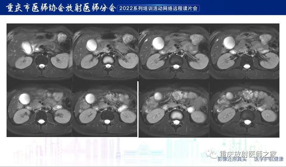 影像PPT - 【病例】肿块型胰腺炎1例CT及MR-7
