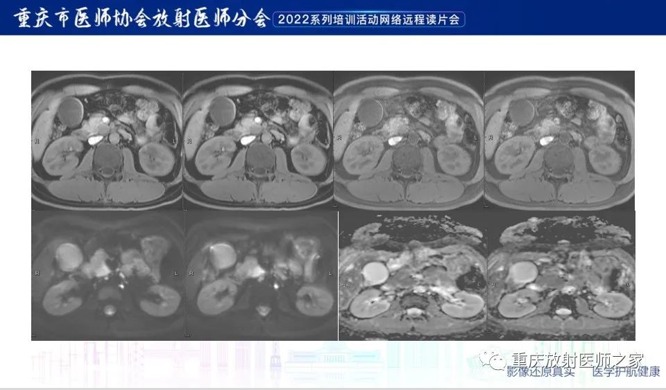 影像PPT - 【病例】肿块型胰腺炎1例CT及MR-8