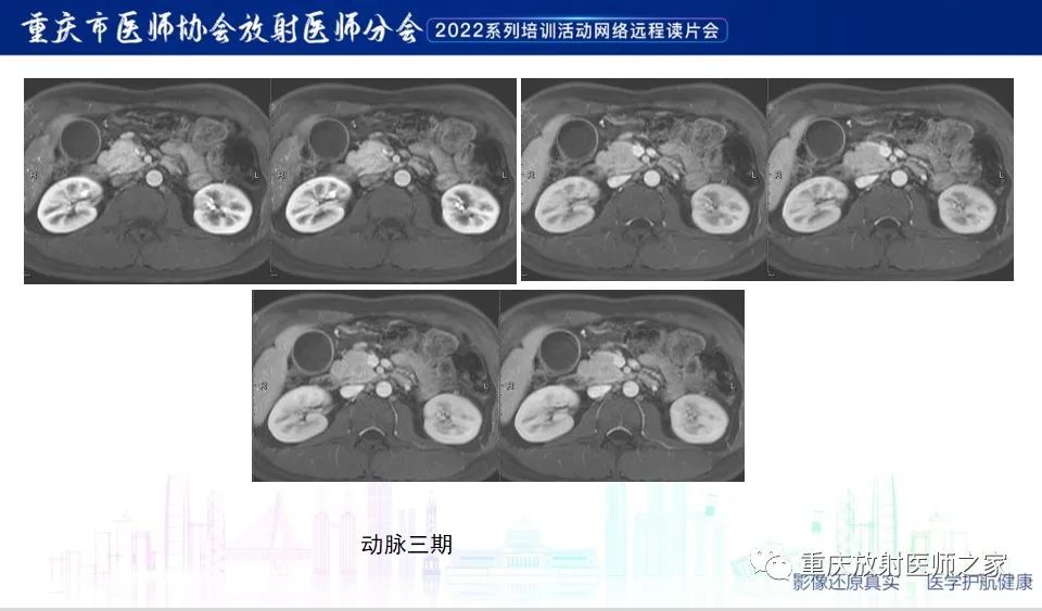 影像PPT - 【病例】肿块型胰腺炎1例CT及MR-9