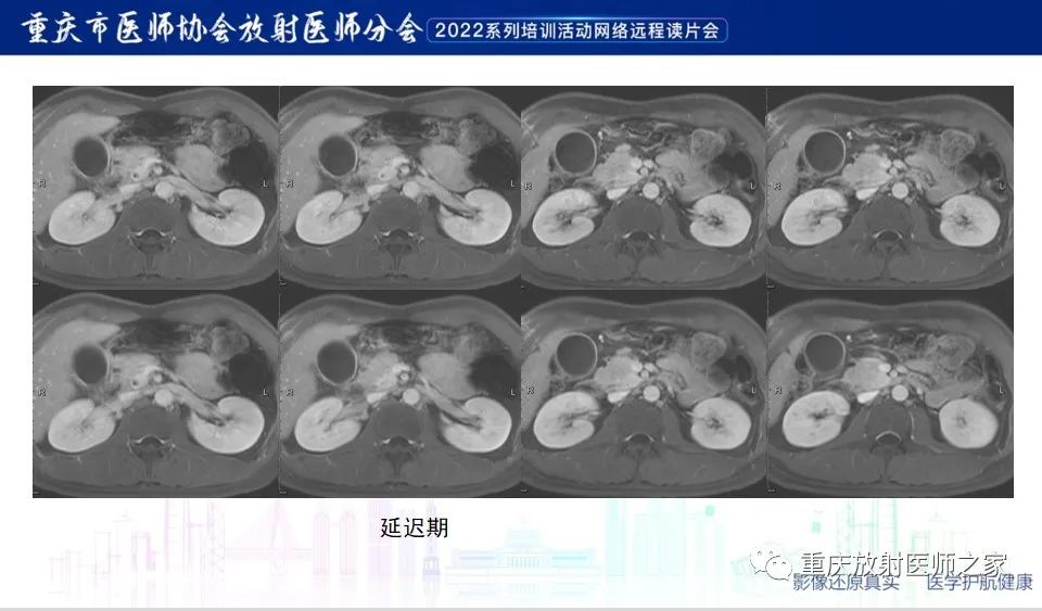 影像PPT - 【病例】肿块型胰腺炎1例CT及MR-10