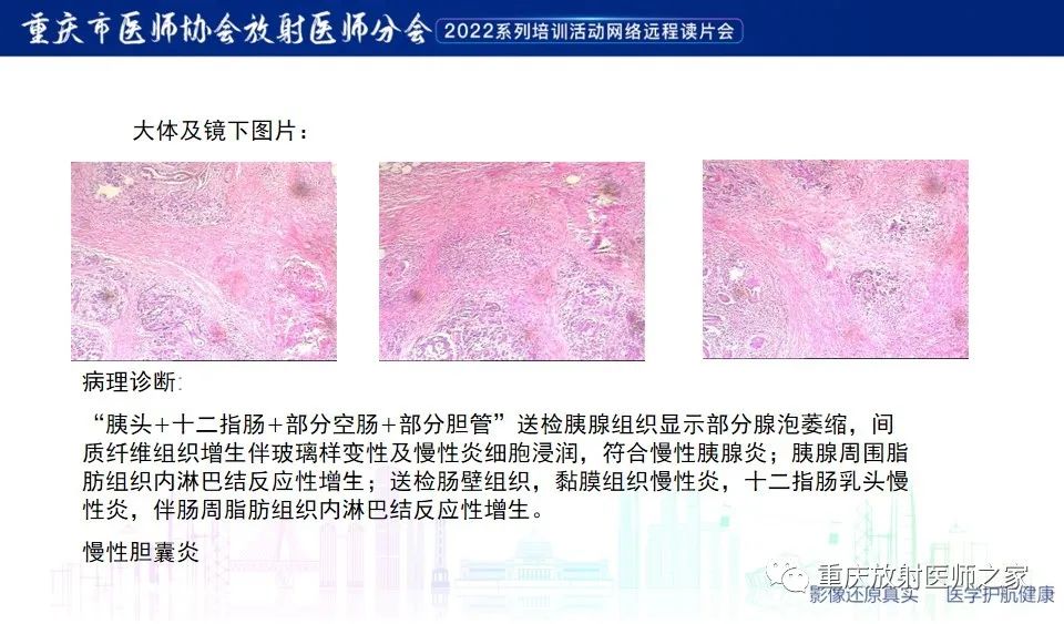 影像PPT - 【病例】肿块型胰腺炎1例CT及MR-11