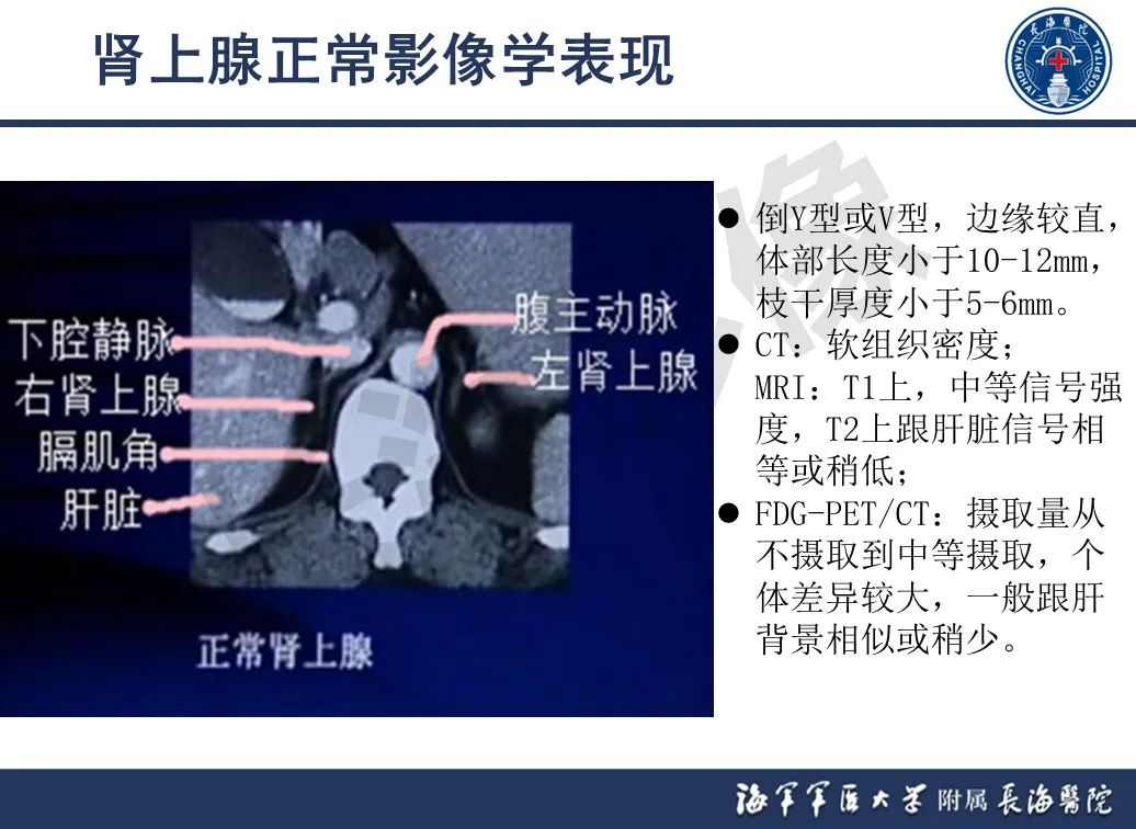 影像PPT - 【PPT】肾上腺占位影像诊断-4