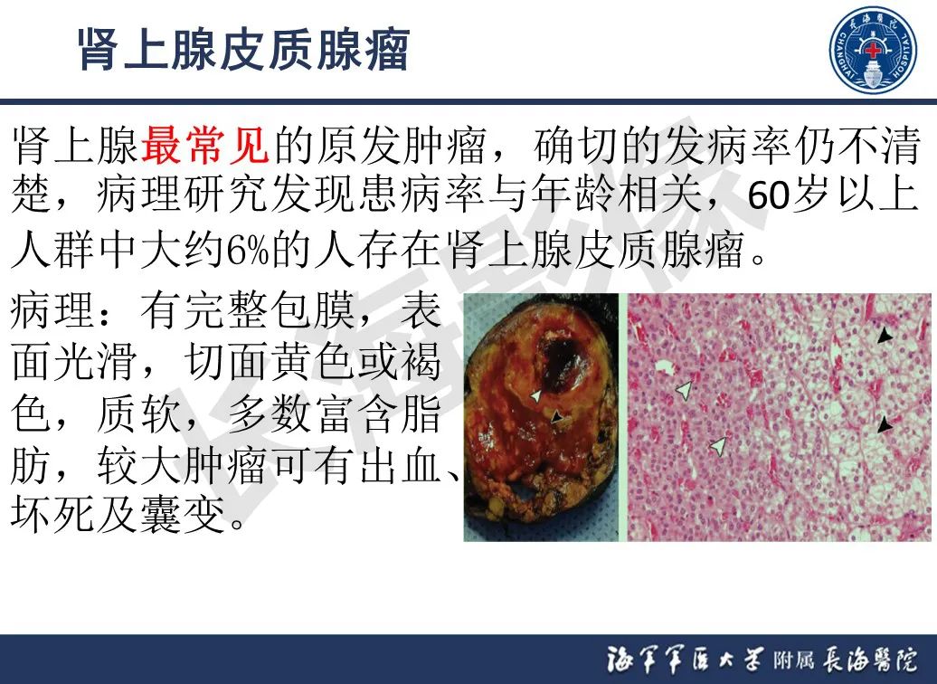 影像PPT - 【PPT】肾上腺占位影像诊断-7