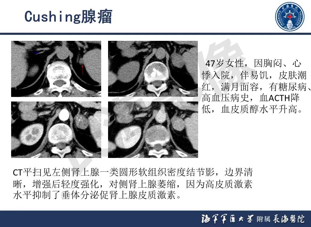 影像PPT - 【PPT】肾上腺占位影像诊断-11