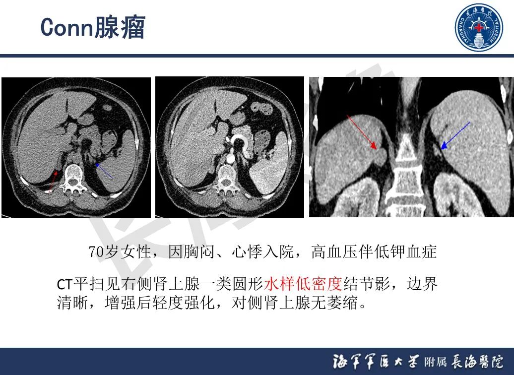 影像PPT - 【PPT】肾上腺占位影像诊断-12
