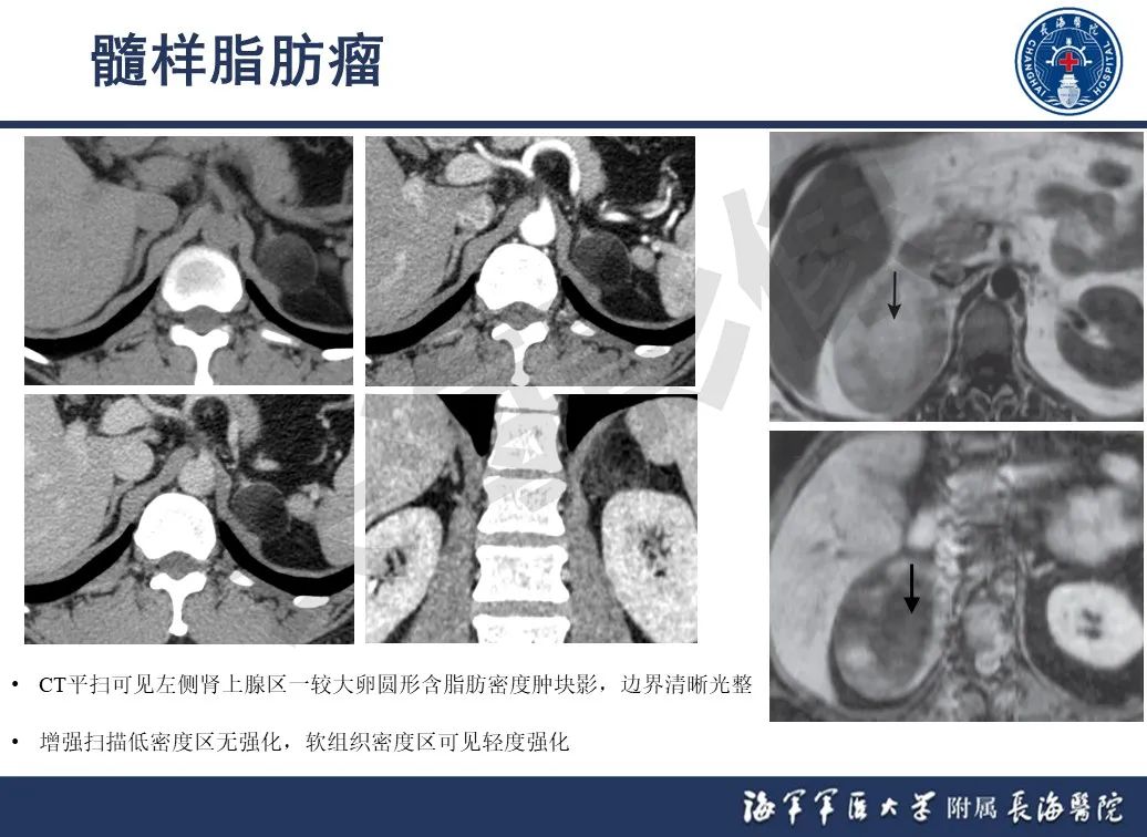 影像PPT - 【PPT】肾上腺占位影像诊断-14