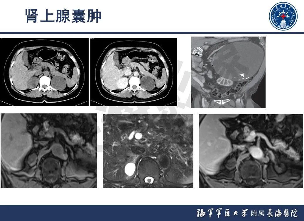 影像PPT - 【PPT】肾上腺占位影像诊断-16