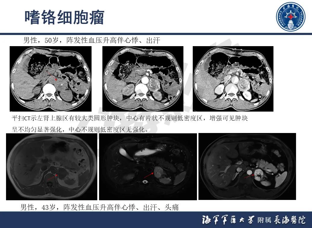 影像PPT - 【PPT】肾上腺占位影像诊断-20