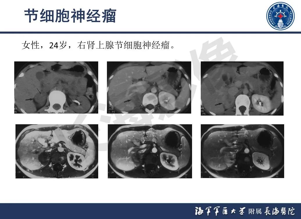 影像PPT - 【PPT】肾上腺占位影像诊断-22