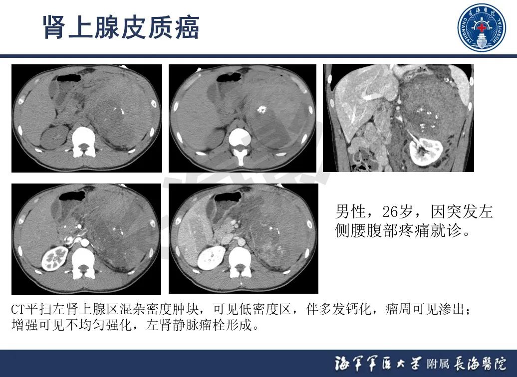 影像PPT - 【PPT】肾上腺占位影像诊断-25