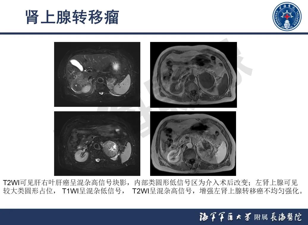 影像PPT - 【PPT】肾上腺占位影像诊断-27