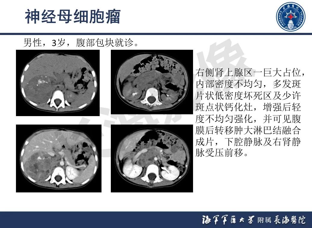 影像PPT - 【PPT】肾上腺占位影像诊断-29