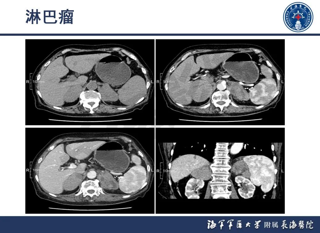 影像PPT - 【PPT】肾上腺占位影像诊断-31