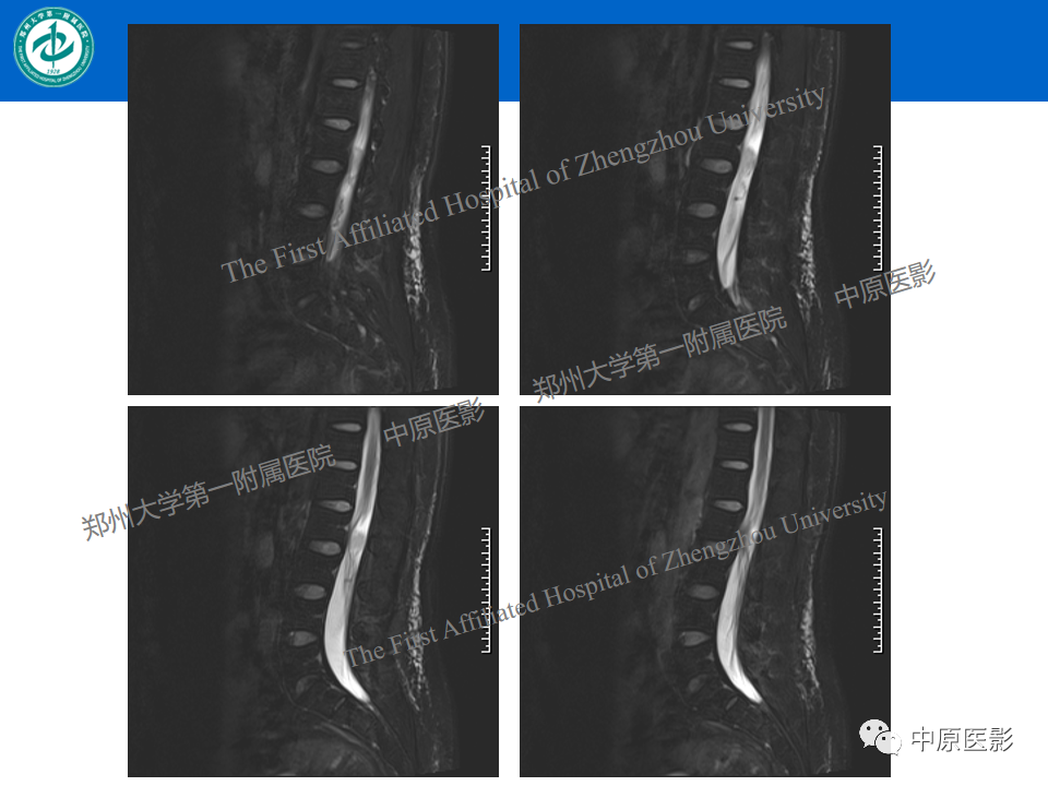 影像PPT - 【病例】腰椎毛细血管瘤1例MR影像-5