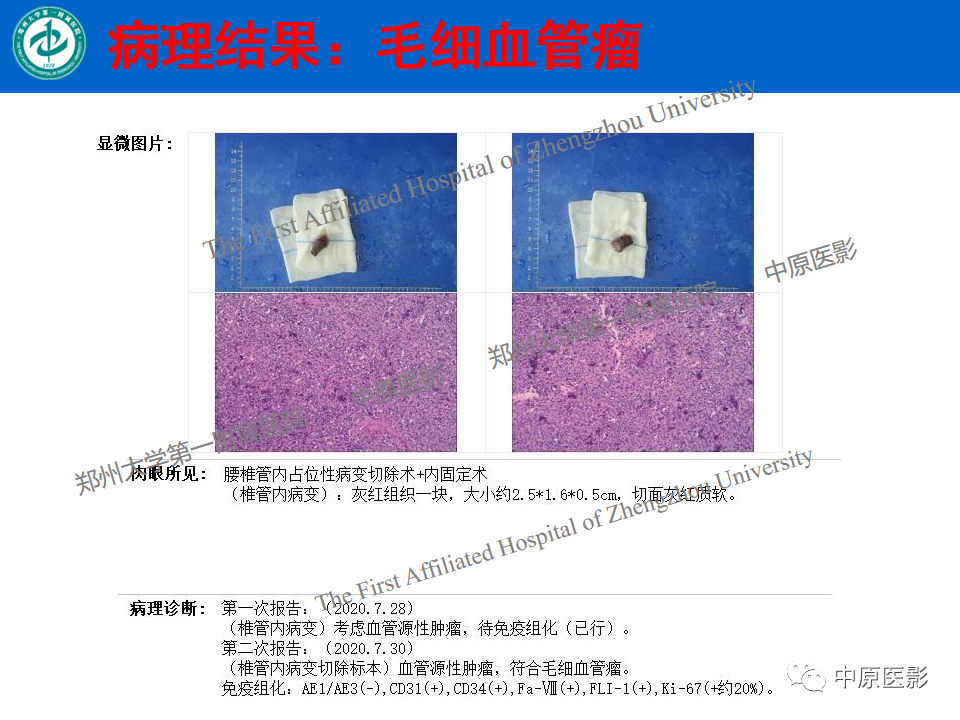 影像PPT - 【病例】腰椎毛细血管瘤1例MR影像-14