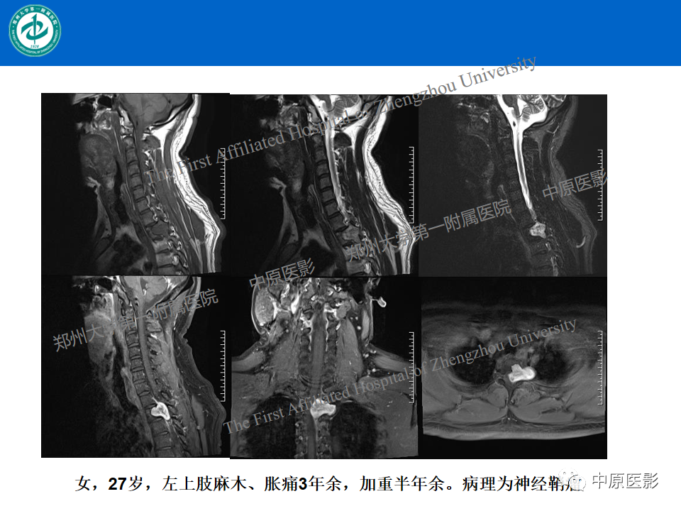 影像PPT - 【病例】腰椎毛细血管瘤1例MR影像-20