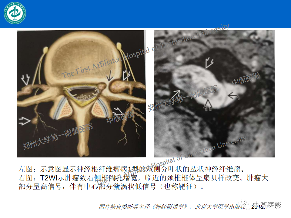 影像PPT - 【病例】腰椎毛细血管瘤1例MR影像-22