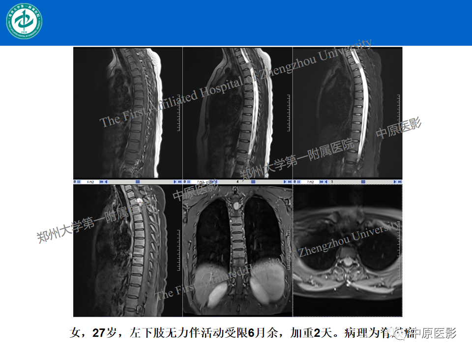 影像PPT - 【病例】腰椎毛细血管瘤1例MR影像-24