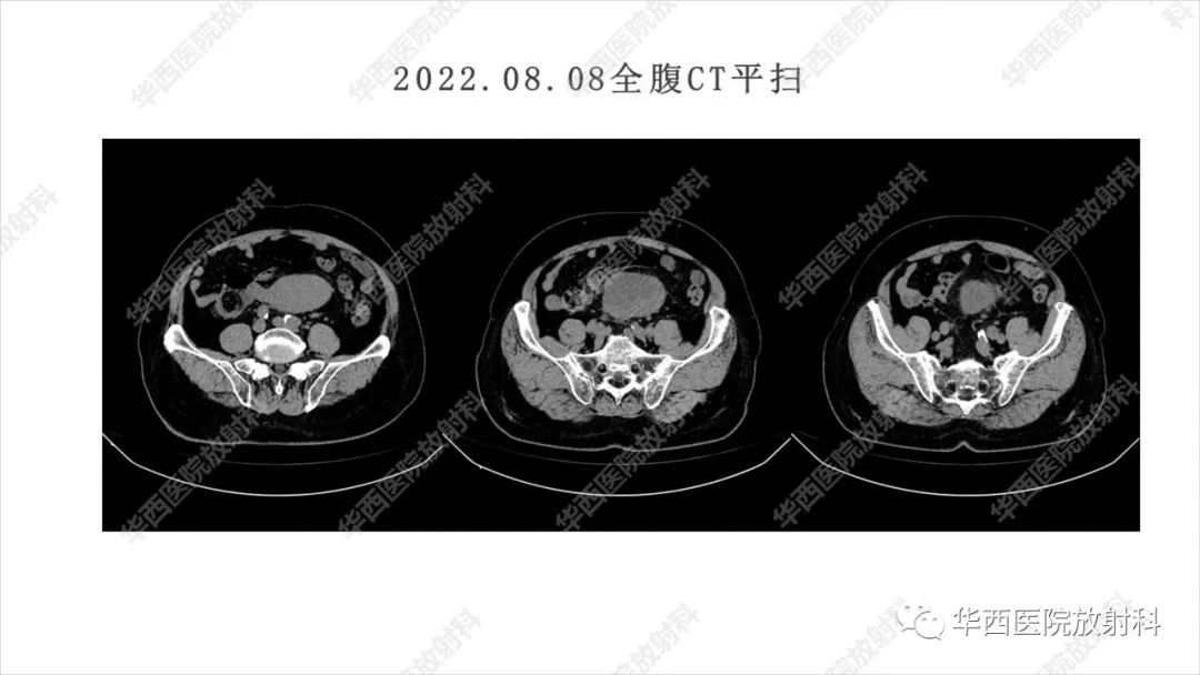 影像PPT - 【病例】阑尾淋巴瘤1例CT及MR影像诊断-4