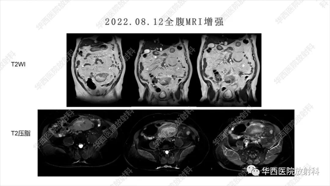 影像PPT - 【病例】阑尾淋巴瘤1例CT及MR影像诊断-5