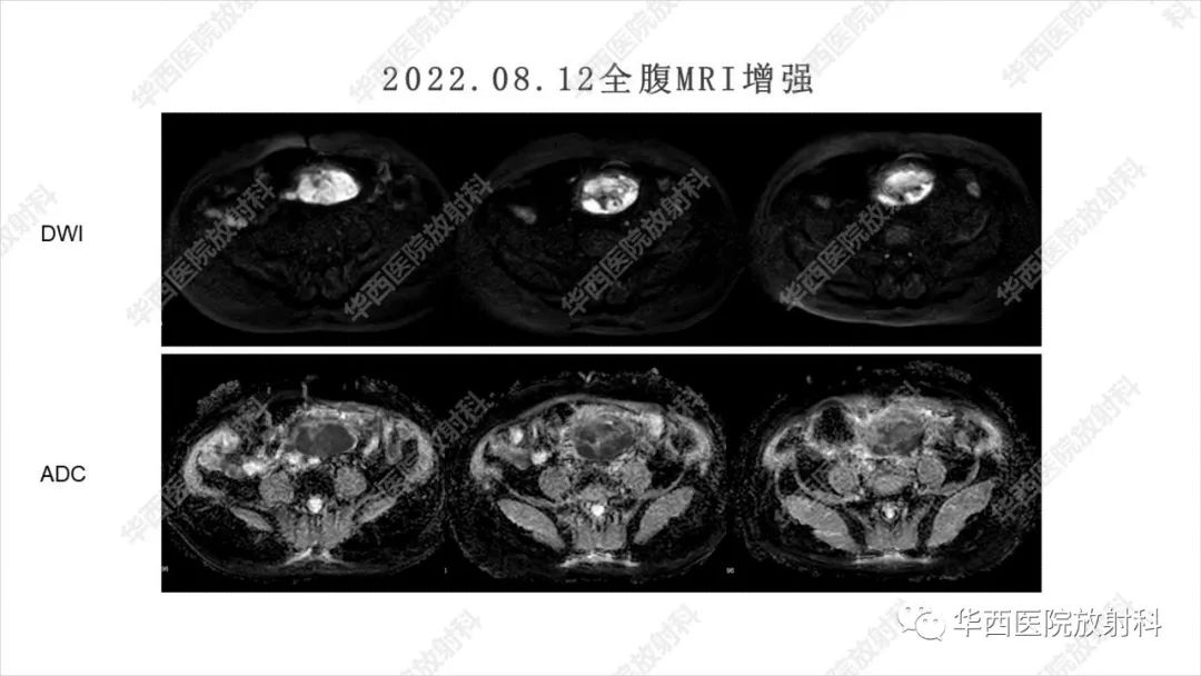 影像PPT - 【病例】阑尾淋巴瘤1例CT及MR影像诊断-6