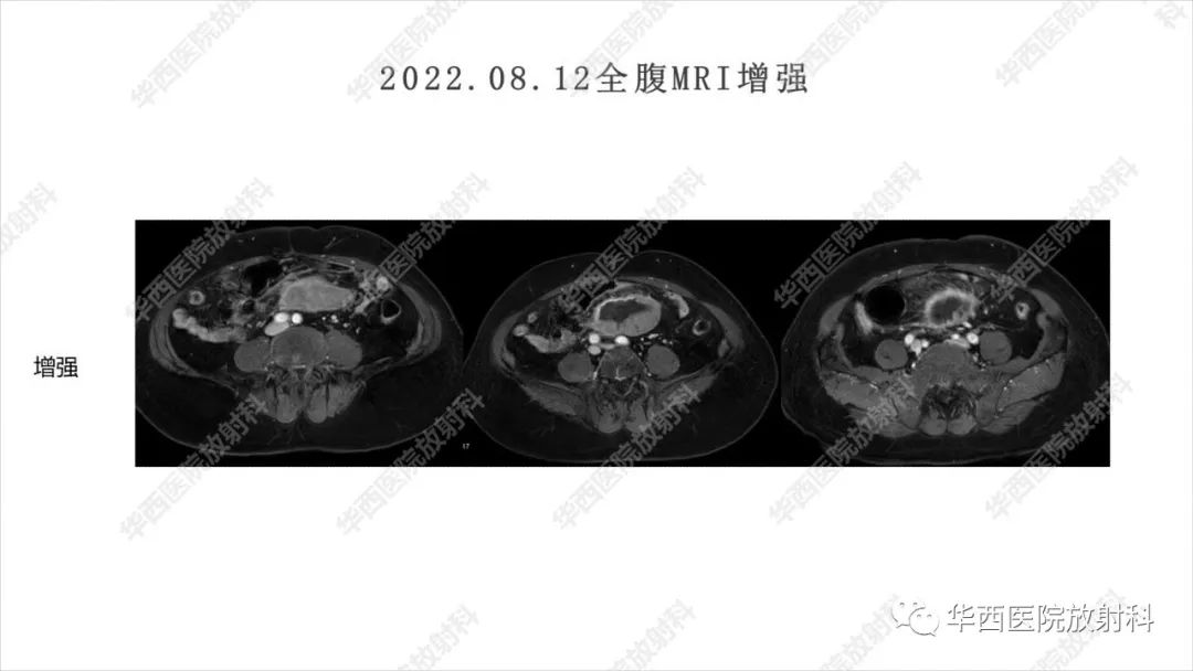 影像PPT - 【病例】阑尾淋巴瘤1例CT及MR影像诊断-7