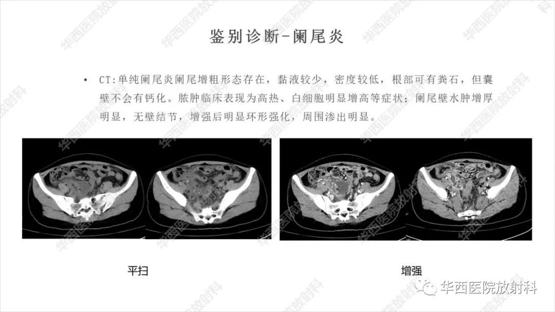 影像PPT - 【病例】阑尾淋巴瘤1例CT及MR影像诊断-2