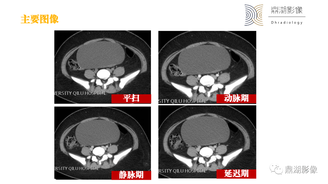 影像PPT - 【PPT】卵巢囊腺瘤/癌诊断及鉴别-6