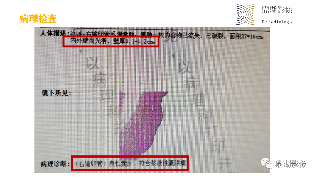 影像PPT - 【PPT】卵巢囊腺瘤/癌诊断及鉴别-8